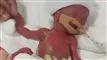 lille baby ligger på hospital