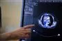 en tumor på en skærm