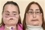 Her ses Connie Culp før og efter sin ansigtstransplantation.
 Foto: AP/Cleveland Clinic-HO / POLFOTO
