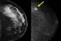 Flere brystscanninger giver mere at lave for lægerne.
 Foto: AP/The Mayo Clinic / POLFOTO