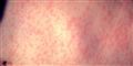 Foto: Centers for Disease Control and Prevention/free